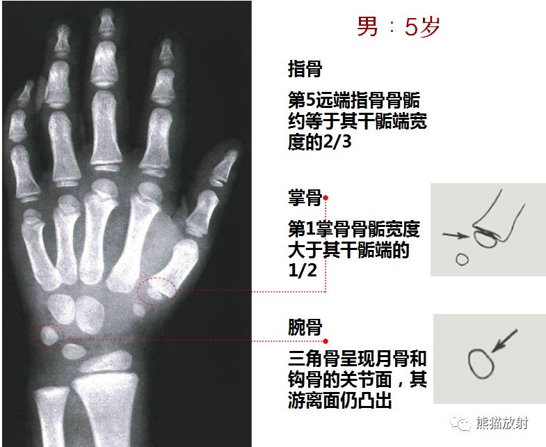 骨龄图谱 骨龄图谱