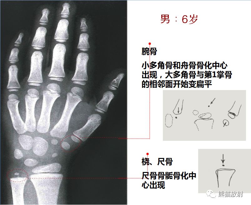 骨龄图谱 骨龄图谱