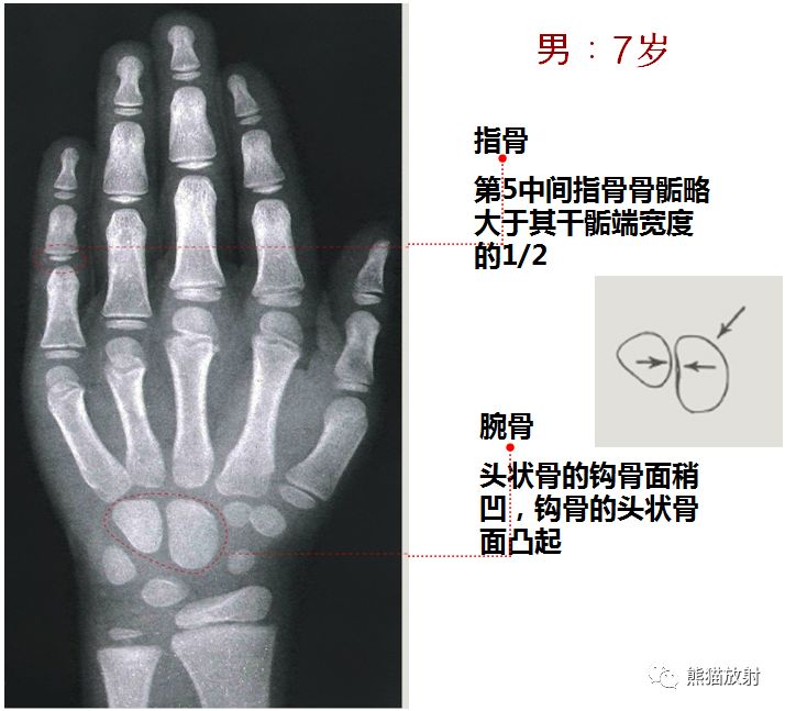 骨龄图谱 骨龄图谱