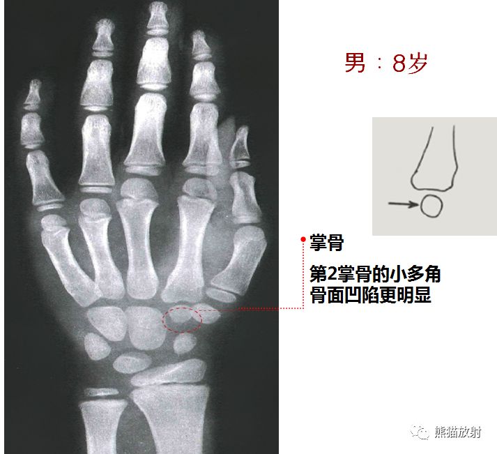 骨龄图谱 骨龄图谱