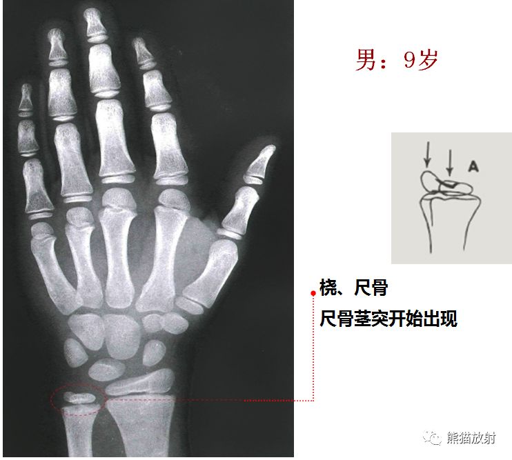 骨龄图谱 骨龄图谱
