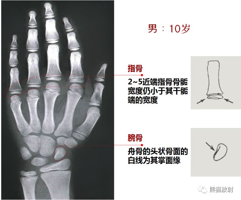 骨龄图谱 骨龄图谱