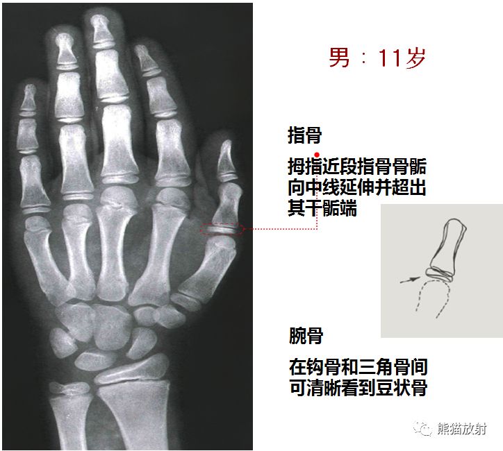 骨龄图谱 骨龄图谱