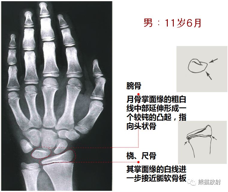 骨龄图谱 骨龄图谱
