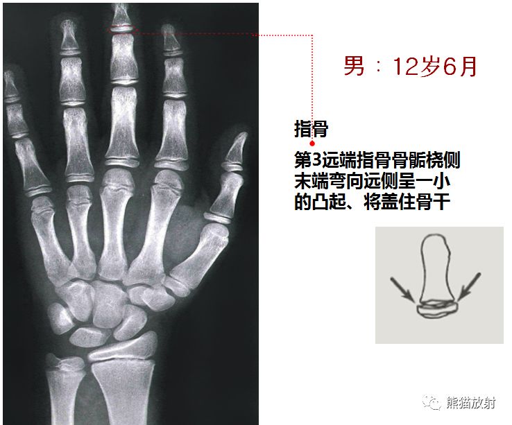 骨龄图谱 骨龄图谱