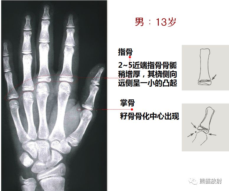 骨龄图谱 骨龄图谱