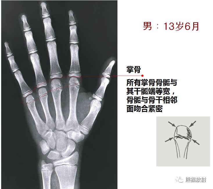 骨龄图谱 骨龄图谱
