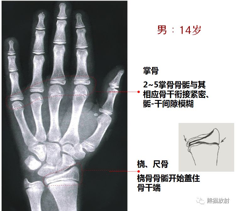 骨龄图谱 骨龄图谱