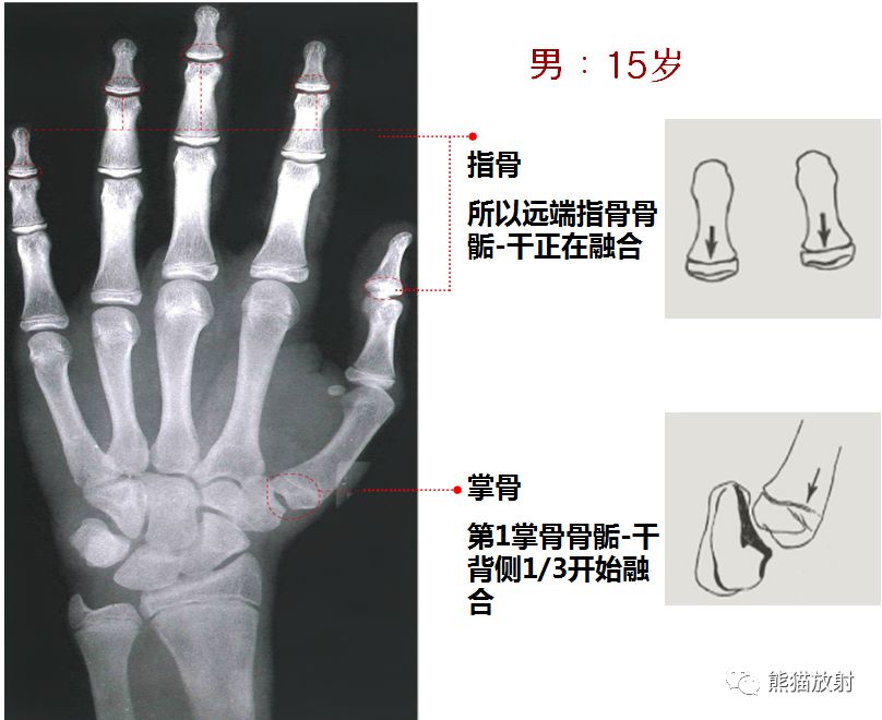 骨龄图谱 骨龄图谱