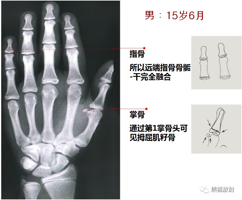 骨龄图谱 骨龄图谱