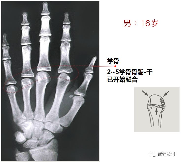 骨龄图谱 骨龄图谱