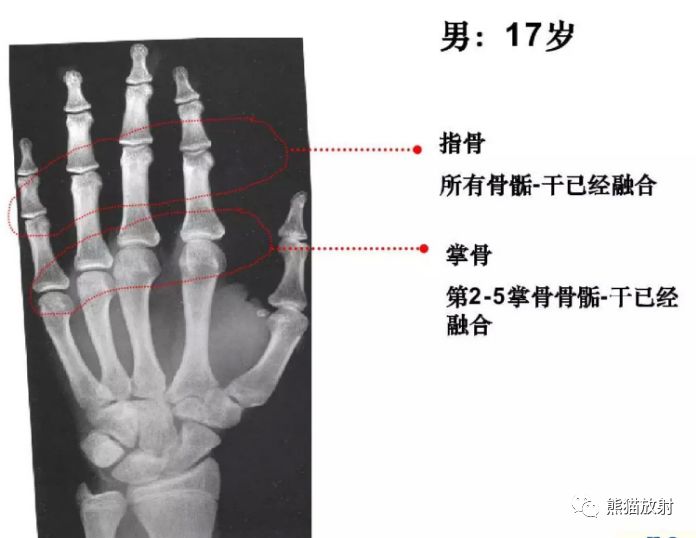 骨龄图谱 骨龄图谱