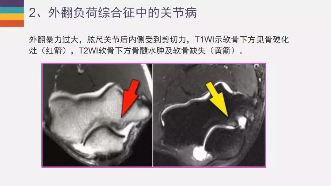 【PPT】肘关节常见病变MR诊断