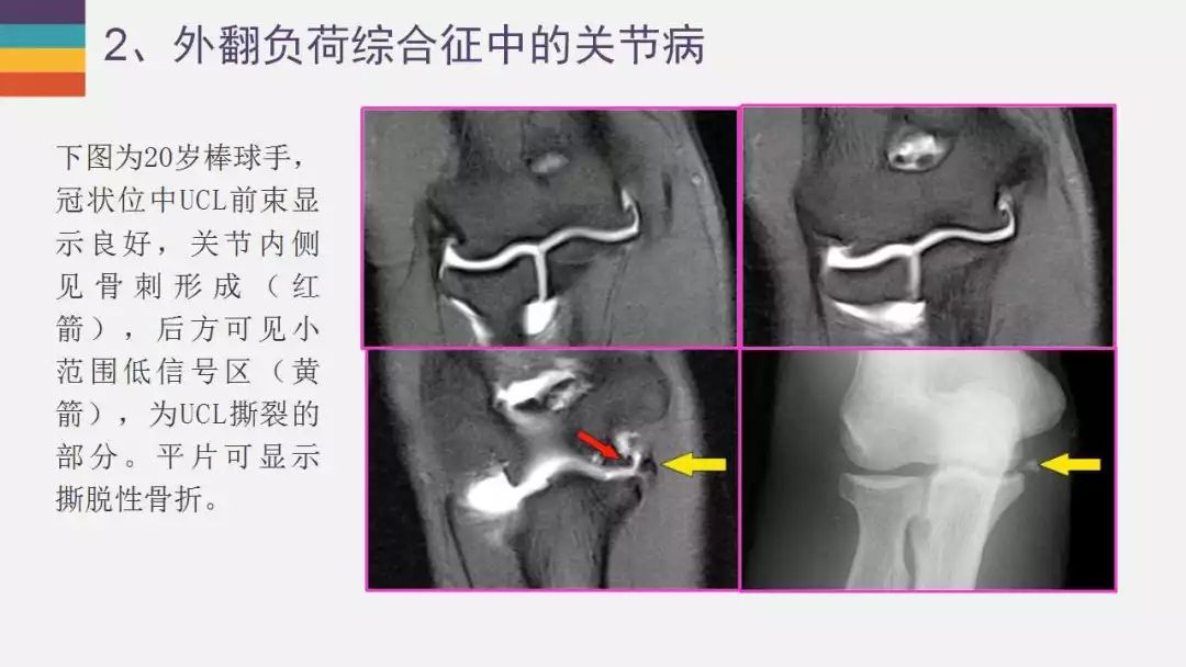 【PPT】肘关节常见病变MR诊断
