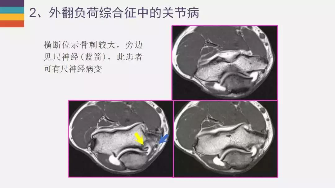 【PPT】肘关节常见病变MR诊断