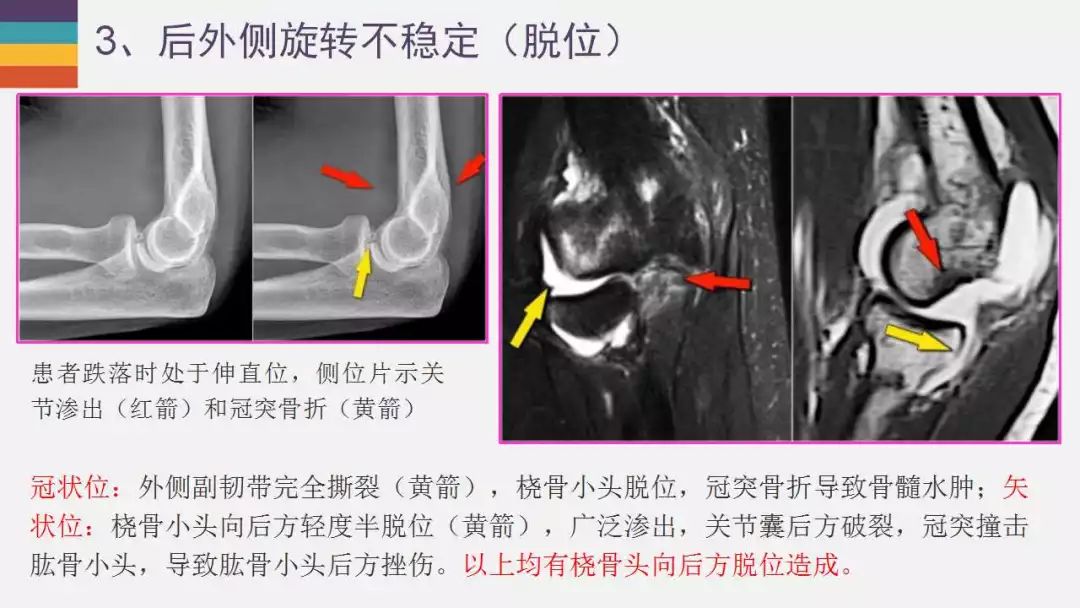 【PPT】肘关节常见病变MR诊断