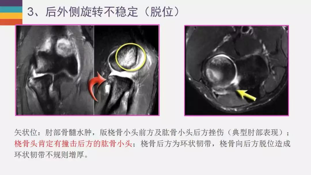 【PPT】肘关节常见病变MR诊断
