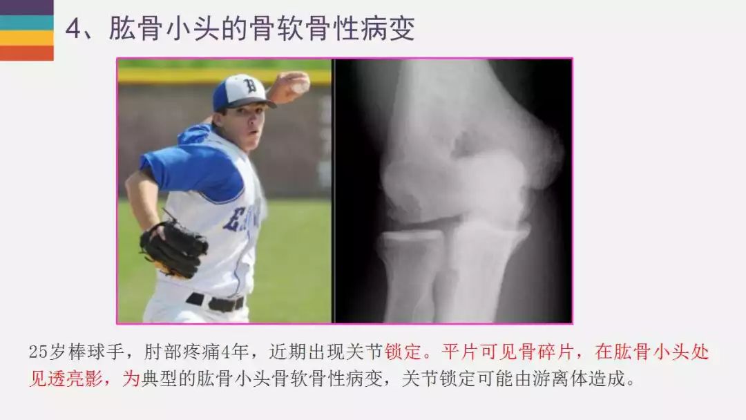 【PPT】肘关节常见病变MR诊断