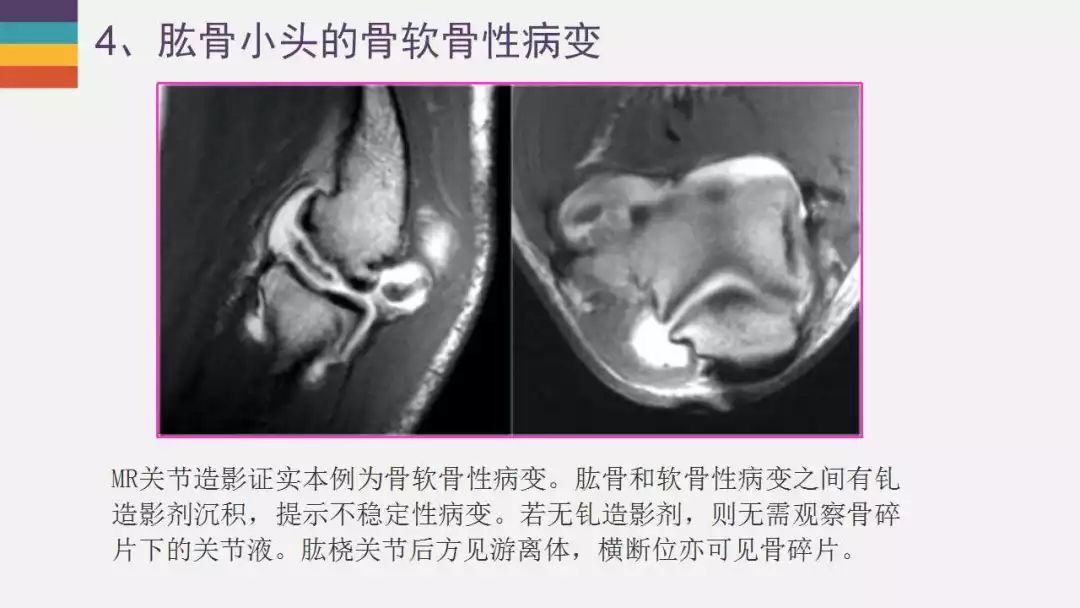 【PPT】肘关节常见病变MR诊断