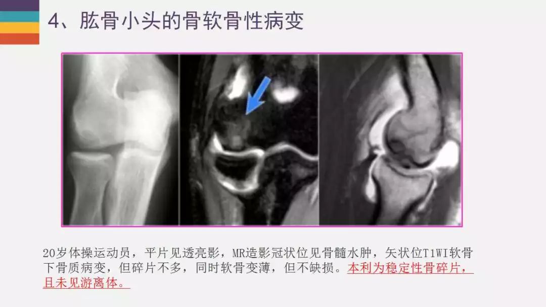 【PPT】肘关节常见病变MR诊断