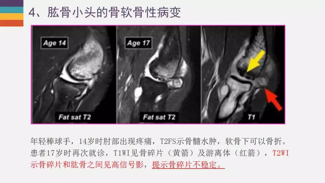 【PPT】肘关节常见病变MR诊断