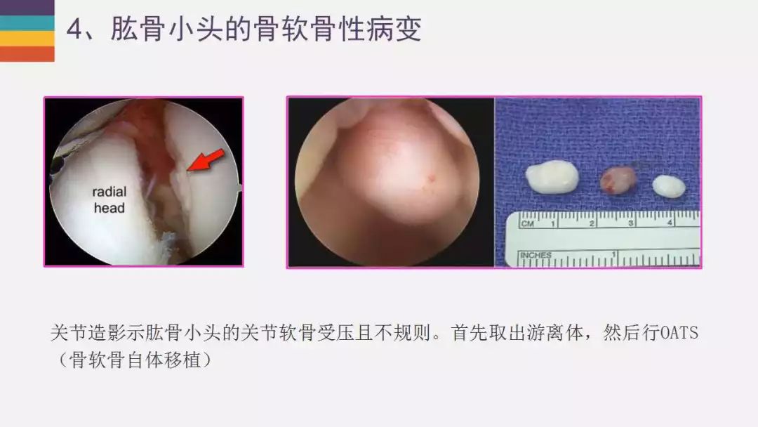 【PPT】肘关节常见病变MR诊断