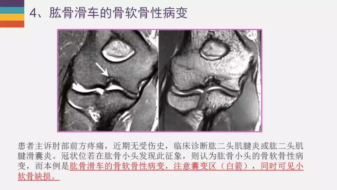 【PPT】肘关节常见病变MR诊断