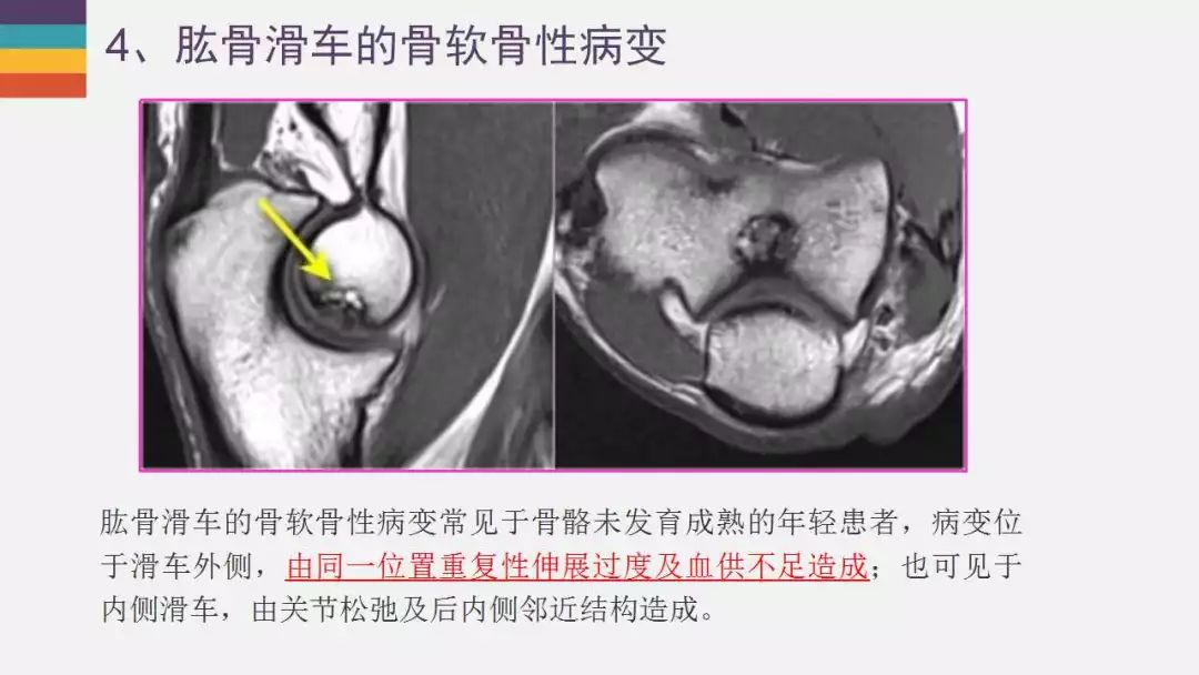 【PPT】肘关节常见病变MR诊断