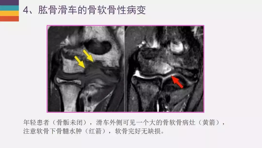 【PPT】肘关节常见病变MR诊断