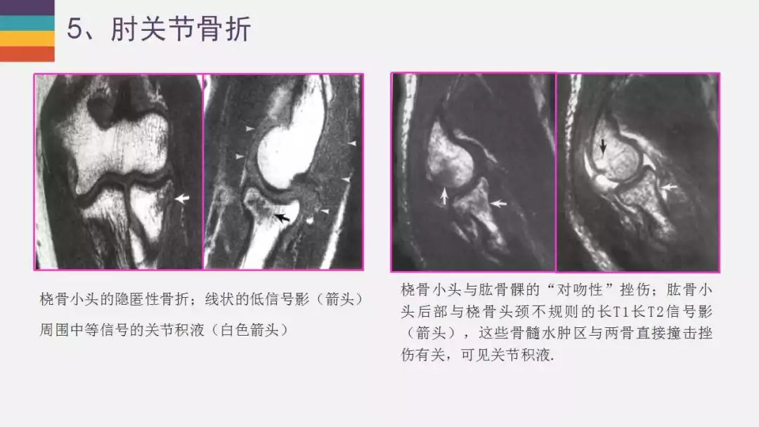 【PPT】肘关节常见病变MR诊断