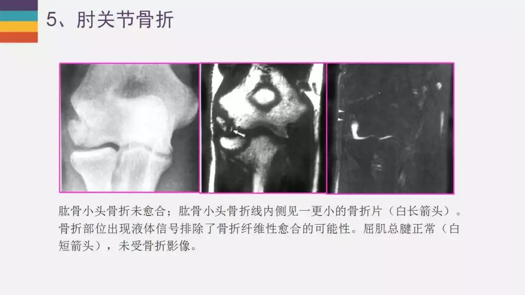 【PPT】肘关节常见病变MR诊断