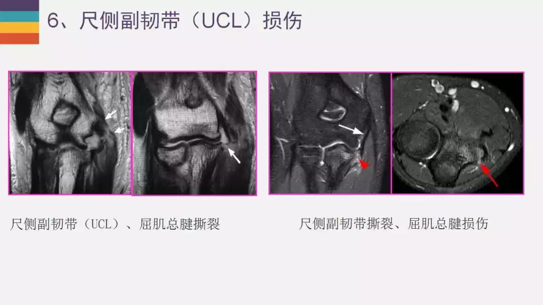 【PPT】肘关节常见病变MR诊断