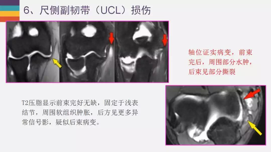【PPT】肘关节常见病变MR诊断