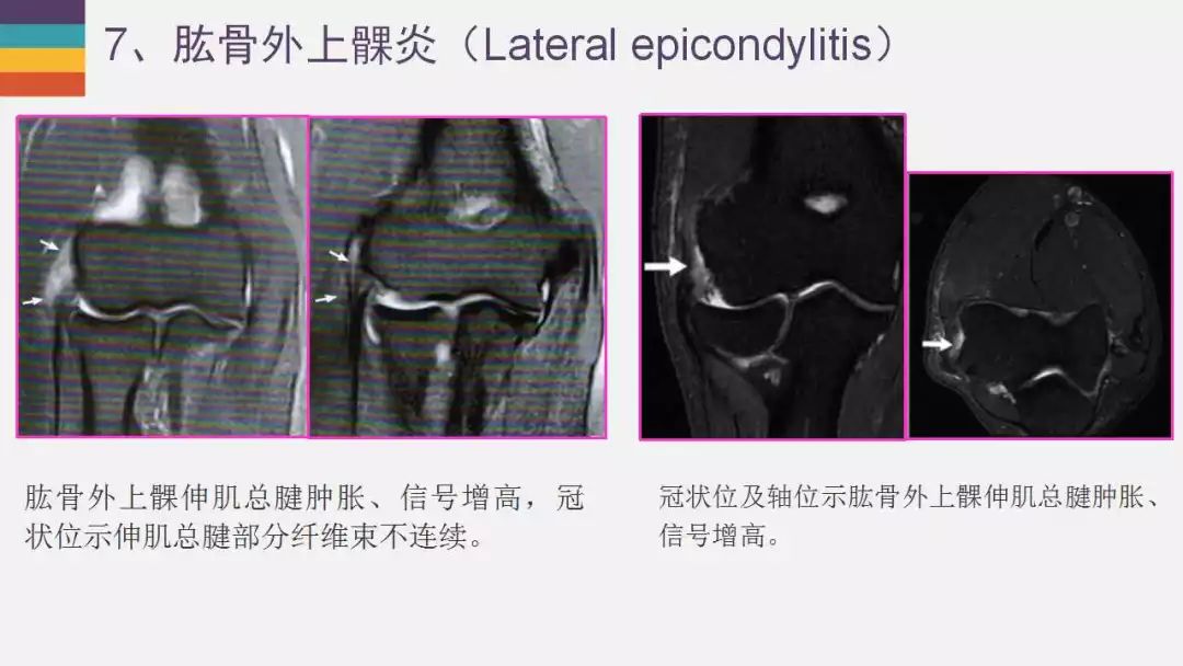 【PPT】肘关节常见病变MR诊断