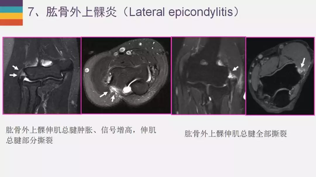 【PPT】肘关节常见病变MR诊断