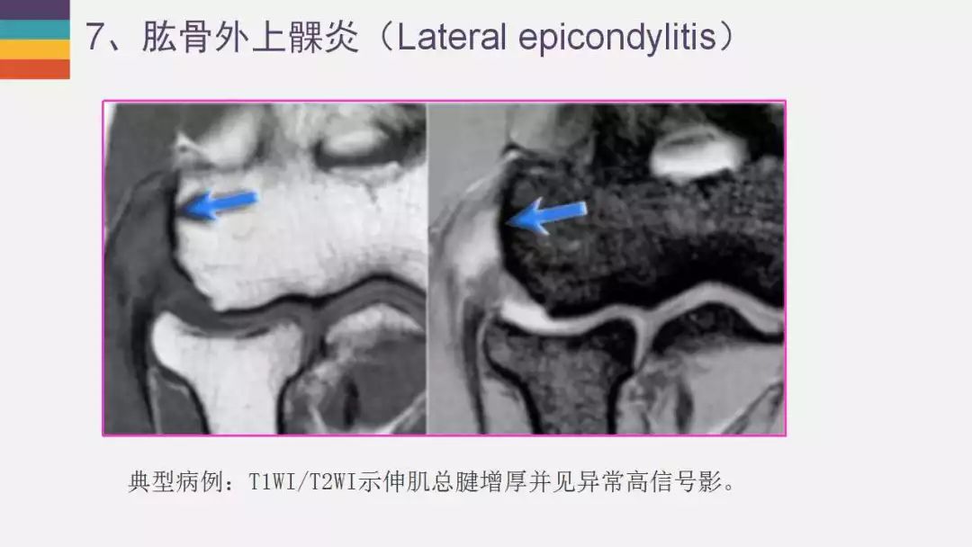 【PPT】肘关节常见病变MR诊断
