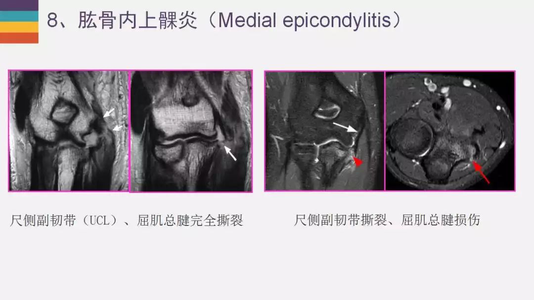 【PPT】肘关节常见病变MR诊断
