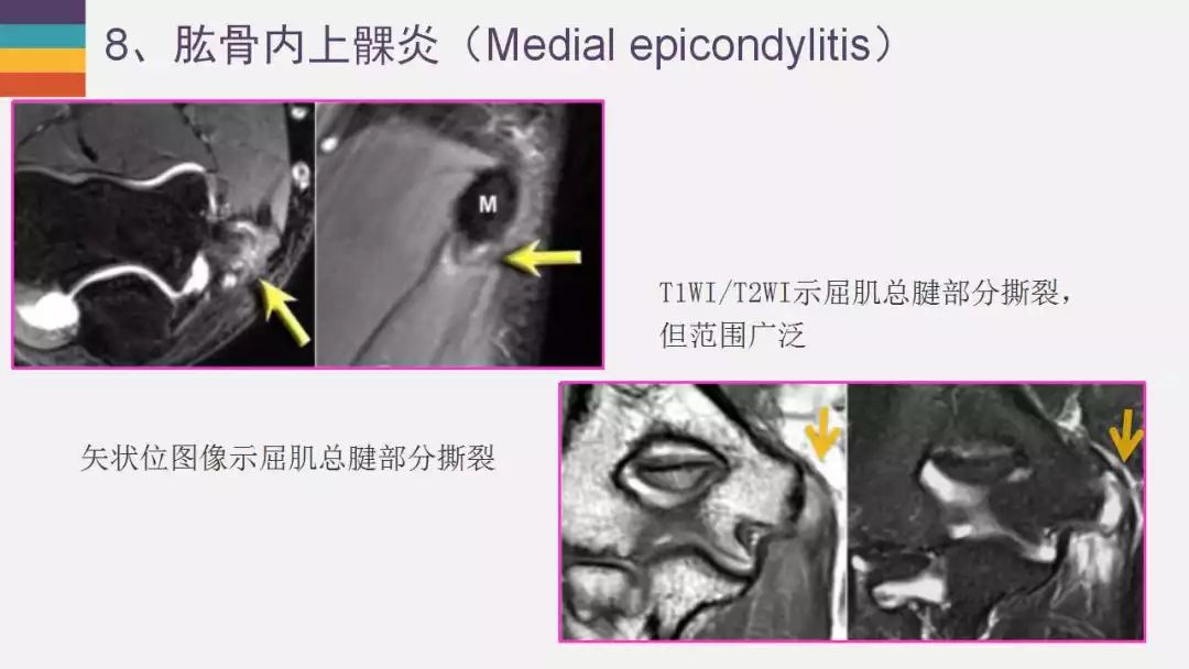 【PPT】肘关节常见病变MR诊断