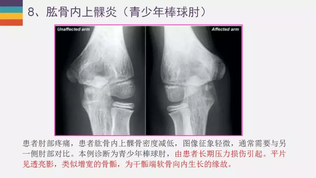 【PPT】肘关节常见病变MR诊断