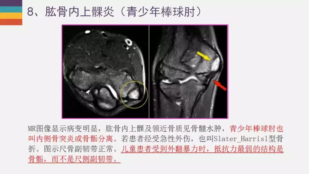 【PPT】肘关节常见病变MR诊断