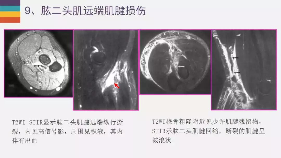 【PPT】肘关节常见病变MR诊断