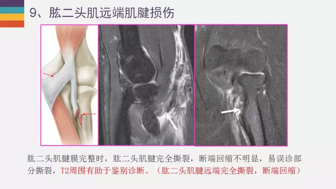 【PPT】肘关节常见病变MR诊断