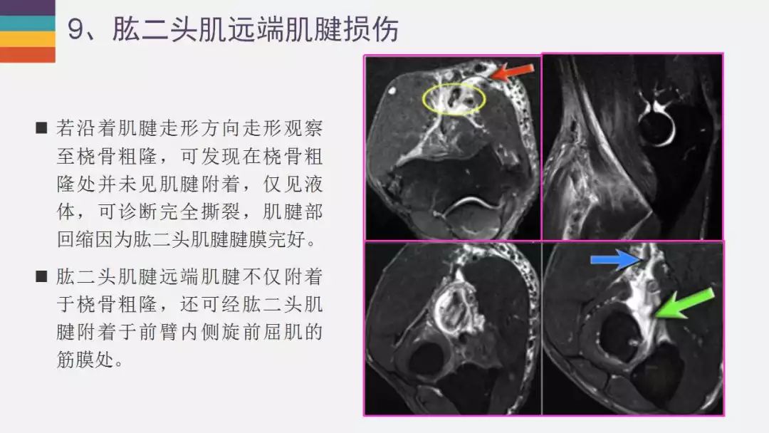 【PPT】肘关节常见病变MR诊断