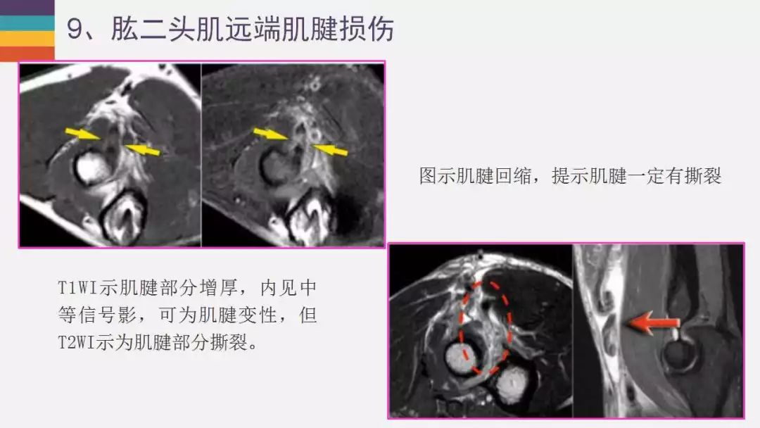 【PPT】肘关节常见病变MR诊断