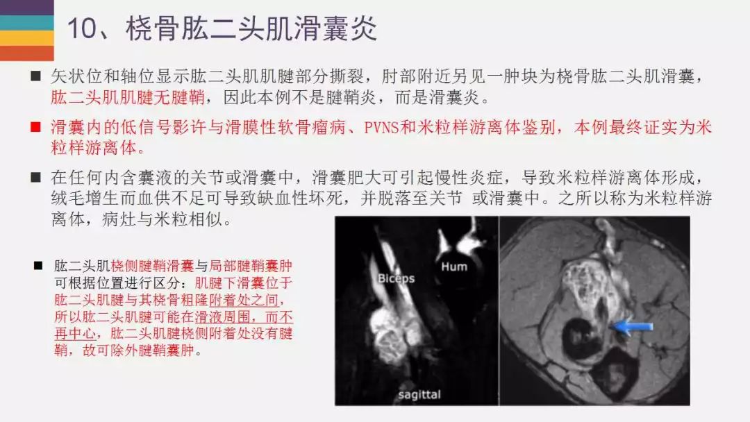 【PPT】肘关节常见病变MR诊断