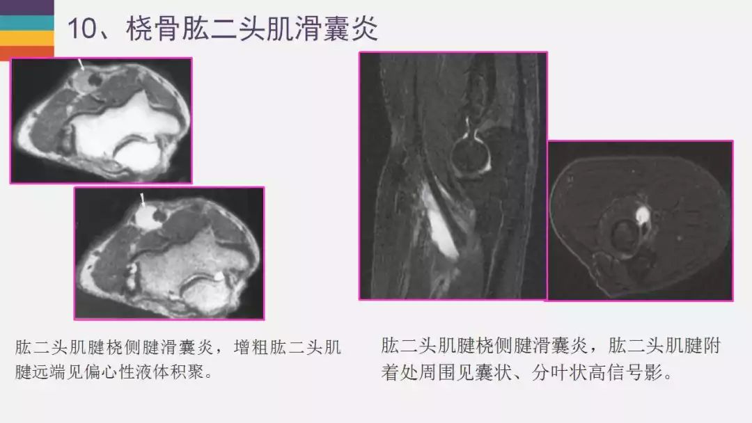 【PPT】肘关节常见病变MR诊断