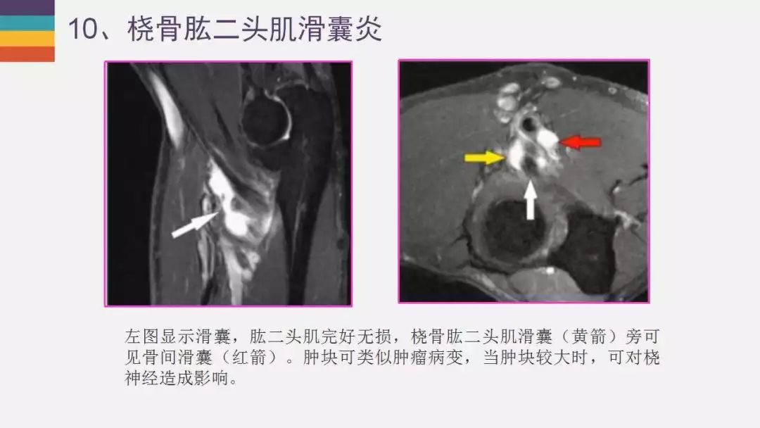 【PPT】肘关节常见病变MR诊断