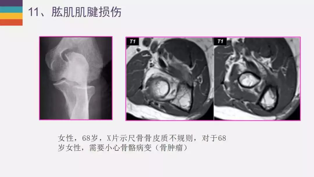 【PPT】肘关节常见病变MR诊断