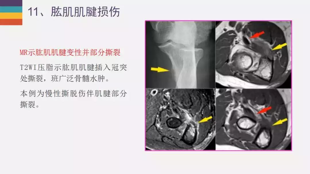 【PPT】肘关节常见病变MR诊断