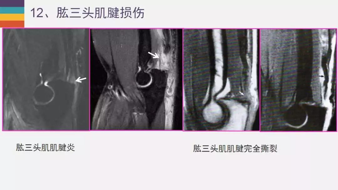 【PPT】肘关节常见病变MR诊断